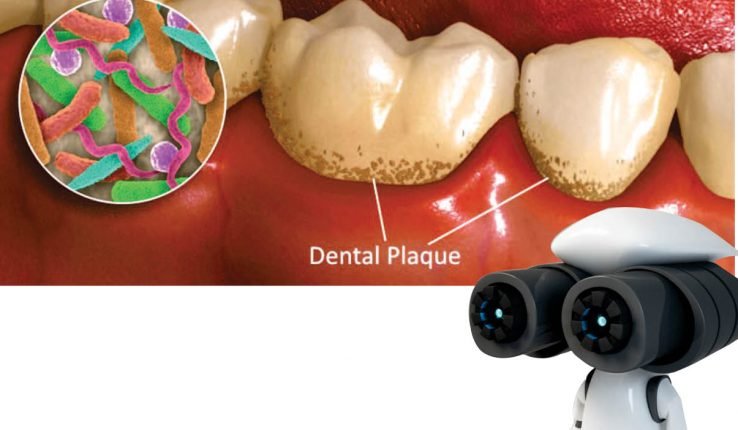 NOW A DENTAL PLAQUE  WILL BE WIPING OUT BY  AN ARMY OF MICRO-ROBOTS